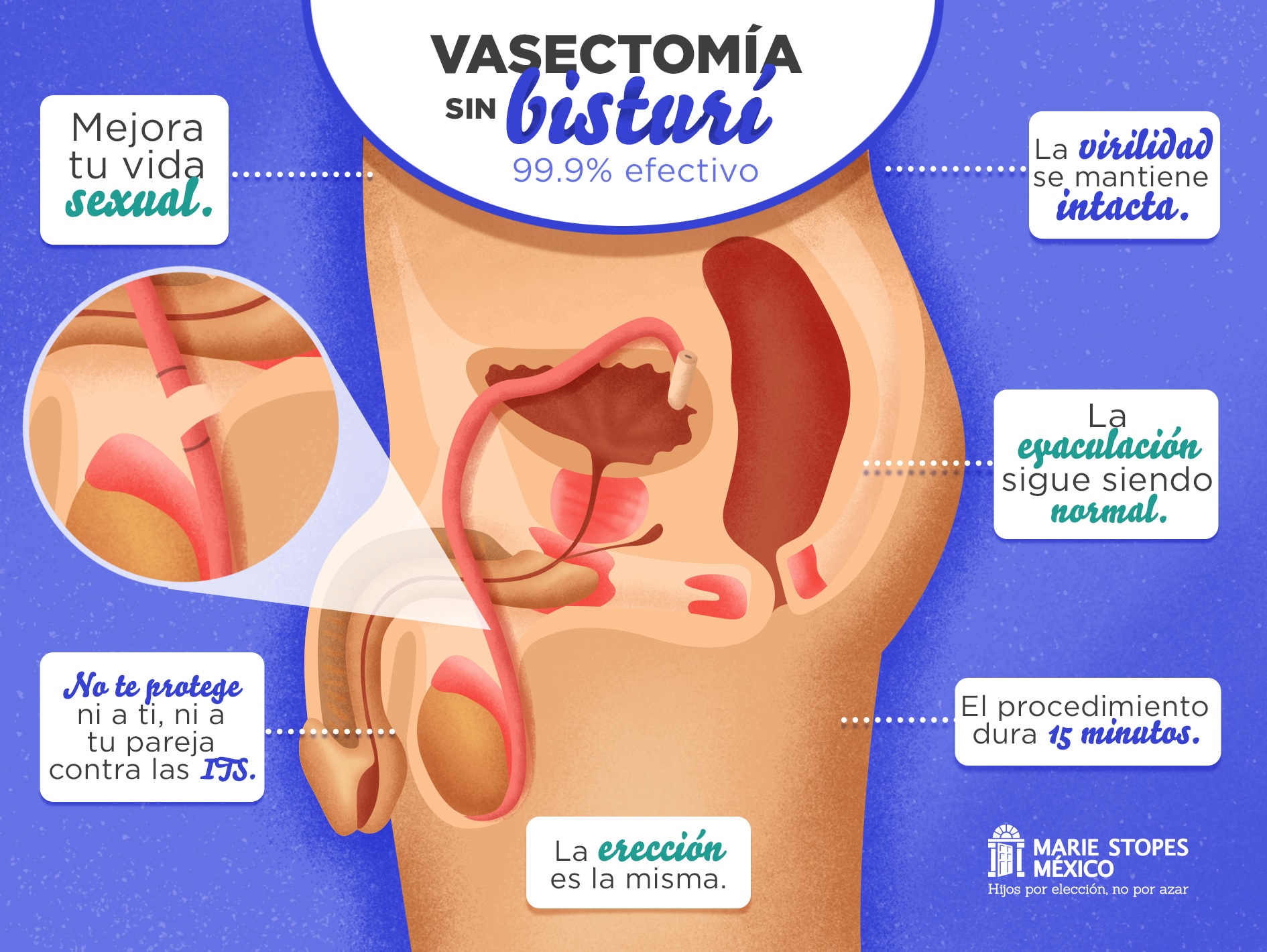 La vida en pareja en tiempos de la vasectomía